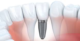 What Happens During A Tooth Implant Process A Dental Implant Timeline