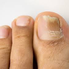 Image result for Onycholysis feet