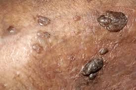 Image result for human papillomavirus symptoms