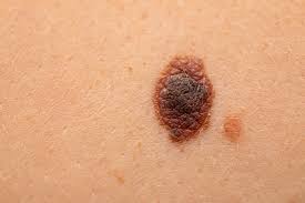 One lesion proved to be a scc and was excised. What Skin Cancer Looks Like