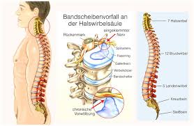 Bandscheibenvorfall An Der Hws Zervikaler Bandscheibenvorfall