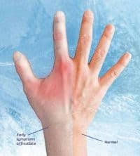 Frostbite, a freezing of living tissue; The Symptoms And Stages Of Frostbite Shoensafety Llc