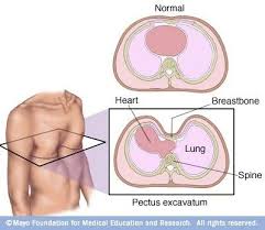 Pin By Fernando On Surgery Pectus Excavatum Marfan Syndrome Heart And Lungs