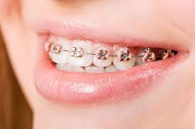 However, in some instances getting braces may be necessary for the patient's overall health. How To Get Free Braces In Australia The No Cost Option For Braces Families Magazine
