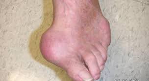 Maybe you would like to learn more about one of these? Gout Buah Pinggang Mybuahpinggang Com