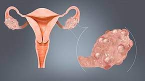 Mature cystic teratomas, also called dermoid cysts, rarely undergo a malignant transformation, i.e. Ovarian Cyst Wikipedia