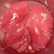 Vereinzelt bemerken betroffene männer und frauen schwäche beziehungsweise müdigkeit. Chlamydien Infektionen Beim Mann