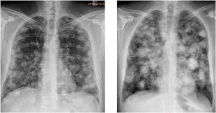 The best way to confirm the diagnosis of testicular cancer is to remove the testicle. Frontiers Severe Complications In Testicular Germ Cell Tumors The Choriocarcinoma Syndrome Endocrinology