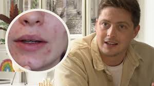 Doctors back calls for mental health support for people with acne