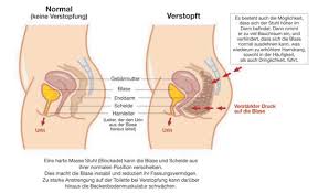 Stuhl und luft, die sich hinter dem darmverschluss ansammeln, blähen den darm auf und erweitern ihn stark. Constipation And Bowel Control In German Continence Foundation Of Australia