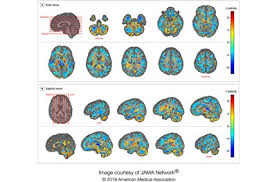 'havana syndrome' likely due to 'directed' radio frequency. Advanced Neuroimaging Shows Brain Matter Alterations In U S Government Personnel Who Developed Neurological Symptoms In Cuba Penn Medicine