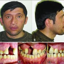 Post-treatment extra oral (a-b) and intra oral (c-e) photographs of the... 
