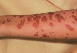 A concise review with a comprehensive summary of therapeutic interventions emphasizing supportive measures.advther. Stevens Johnson Syndrome And Toxic Epidermal Necrolysis The Pharmaceutical Journal