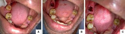 In this video, you will learn helpful tips on what to do to prevent bleeding, what to do to stop bleeding after tooth extraction, and how to troubleshoot in. Prospective Comparative Evaluation Of Post Extraction Bleeding In Cardiovascular Compromised Patients With And Without Antiplatelet Medications Springerlink
