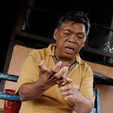 Kumuh, miskin, terpinggirkan, sangat menular penyakit kusta berasal dari bahasa india kustha, dan dalam berbagai budaya bangsa telah dikenal bahkan sejak era sebelum masehi. Melawan Stigma Kusta Jangan Kucilkan Mereka 2 Halaman All Kompas Com