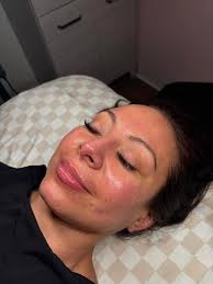Dermaplane facial services available in Lawton
