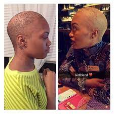 Everypost Hair Loss Men Bald Hair Bald Spots Women