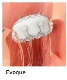 Physician Resource Novel And Less Invasive Options For Tricuspid Valve Regurgitation Now Available Through Clinical Trials Enrolling At Uva Physician Resource