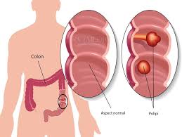 Sono del tutto asintomatiche e utilizzate come elemento di screening clinico della poliposi e anticipare la comparsa dei polipi del colon. Diagnosticul De Polip Colon Ce Trebuie SÄƒ È™tii
