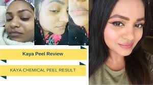 The device is created to specifically and selectively target the darker hair while leaving the surrounding brighter area intact.for that reason, it is very effective in removing hair in small areas like the upper lip, beard, or bikini. Kaya Skin Peel Treatment Review Kaya Peel Experience Chemical Peel India Youtube