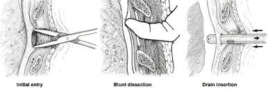 Image result for Blunt Dissection