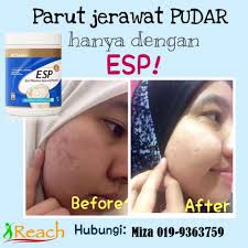 Berikut ini adalah cara yang cepat, ampuh, dan aman untuk. Cara Hilangkan Parut Jerawat Berlubang Berkesan Pendankertasdotcom