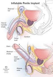 Penile Implant: Purpose, Procedure, Risks & Recovery