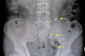 5 Tips For Kidney Stone Prevention Commonwealth Nephrology Associates Depending on the urinary ph, the substance settles small kidney stones often travel through the ureters and bladder by themselves. 5 tips for kidney stone prevention commonwealth nephrology associates