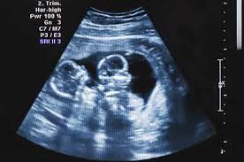 Rever D Une Echographie Les Jumeaux Interpretations Significations Echographie Jumeaux Reve