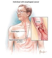 Nasopharyngeal cancer affects the part of the throat that connects the back of the nose to the back of the mouth. Esophageal Cancer Mouth And Tongue Cancers Library
