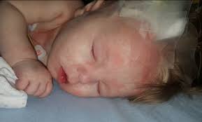 Download all photos and use them even for commercial projects. Meningitis Rash Completely Covers Baby S Body In 12 Hours Mom Warns Cbs News