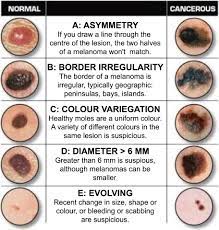 Melanoma is the most serious type of skin cancer that can start as a changing skin lesion (change in an existing mole or freckle), but it is more likely to … Skin Lesions Dr Dirk Lazarus Plastic Surgeon