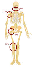 Diagnosis of bone cancer in dogs. Osteosarcoma Wikipedia