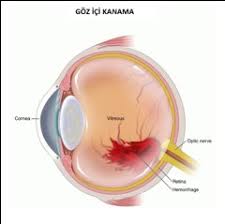 Goz Ici Kanamalari Prof Dr Gokhan Gulkilik
