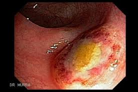 Typhoid Ulcers El Salvador Atlas Of Gastrointestinal Video Endoscopy Gastrointestinalatlas Com