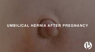 Will a hernia go away. Postpartum Umbilical Hernia After Pregnancy Beyondfit Mom