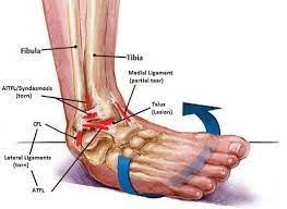 The patellofemoral articulation, consisting of the patella, or kneecap, and the patellar groove on the front of the femur through which it slides; Lateral Ankle Sprains Explained Diversified Integrated Sports Clinic