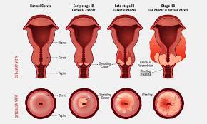 Get professional recommendation at the reasons of cervical most cancers, signs and symptoms, diagnosis and. D E S Is It Several Cases Of Clear Cell Adenocarcinoma Cca In Des Granddaughters Diethylstilbestrol