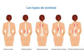 La douleur dans la partie haute du dos peut devenir assez grave pour limiter les activités, elle ressemble habituellement à une douleur vive et brûlante localisée symptômes courants de douleur dans le haut du dos. C Kpt Dhmf6ihm