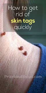 How To Get Rid Of Skin Tags Yourself Quickly Skin Tag Removal Skin Tags On Face Remove Skin Tags Naturally