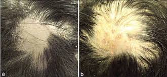 Scalp psoriasis itself doesn't cause hair loss, but scratching a lot or very hard, picking at the scaly spots, harsh treatments, and the stress that goes along with the this can also cause problems with hair and scalp health and many psoriasis sufferers experience thinning of their hair as a result. View Image