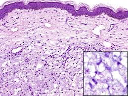 Check spelling or type a new query. Histopathologic Review Of Granulomatous Inflammation Sciencedirect