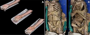 Short video of anterior abdominal wall muscles of the torso indentifies: Stepwise Dissection Models A Anterior Forearm And Wrist And B Download Scientific Diagram