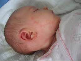 Résultats test sanguin protéines lait juin les allergies alimentaires et la prise de sang spécifique. Iplv Ou Non Biberons Et Sevrage Forum Grossesse Amp Bebe Doctissimo