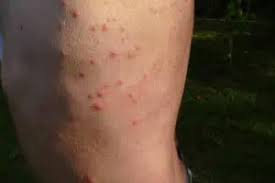 Image result for bedbug bites look like