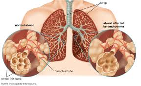 What are the 4 stages of emphysema. Emphysema Medical Disorder Britannica
