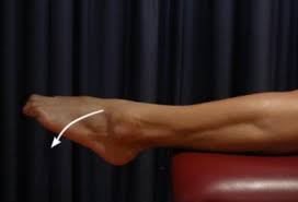 Image result for Ankle Dislocation