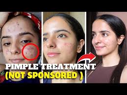 My Acne journey *2Products that changed my life*