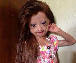 Adalia Rose The Girl With Progeria Facts Her Family Life