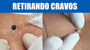 Mas e as outras partes do seu outra questão assustadora sobre os cravos é que mesmo com a retirada do bolo sebáceo os micro. Retirando Cravos Enormes Relaxante Squeezing Clove Remove Blackheads And Pimples Youtube